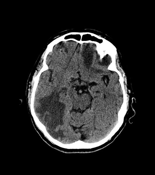 File:Cholangiocarcinoma with cerebral metastases (Radiopaedia 83519-98628 Axial non-contrast 29).jpg