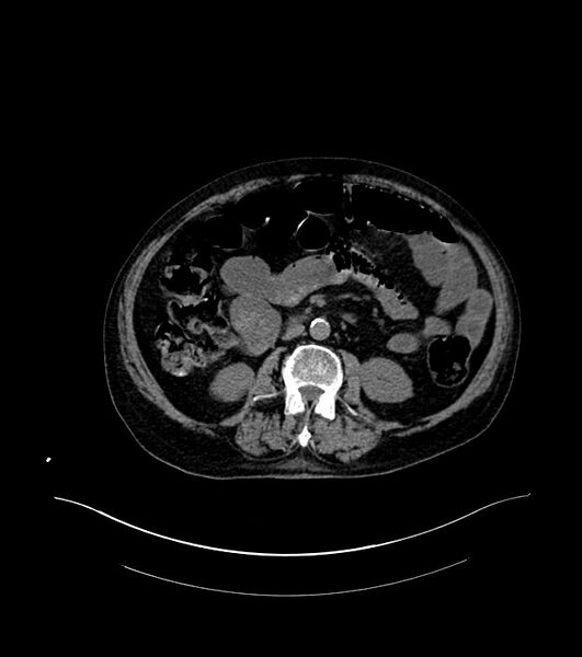 File:Cholangiocarcinoma with cerebral metastases (Radiopaedia 83519-98629 Axial non-contrast 55).jpg