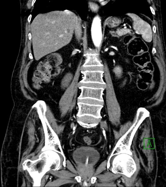 File:Cholangiocarcinoma with cerebral metastases (Radiopaedia 83519-98629 E 53).jpg