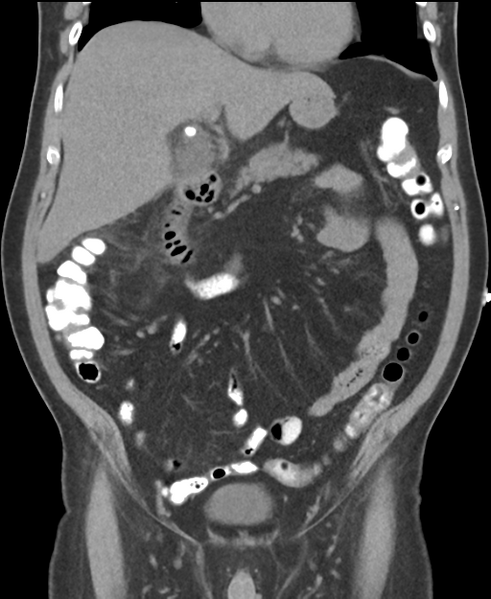 File:Cholecystitis with focal perforation and hepatic abscess (Radiopaedia 37189-38945 Coronal non-contrast 23).png