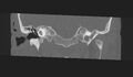 Cholesteatoma (Radiopaedia 10742-11203 Coronal bone window 7).jpg