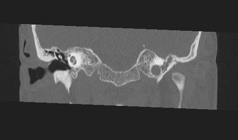 File:Cholesteatoma (Radiopaedia 10742-11203 Coronal bone window 7).jpg