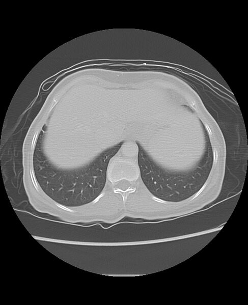 File:Chondrosarcoma (Radiopaedia 79427-92532 Axial lung window 49).jpg