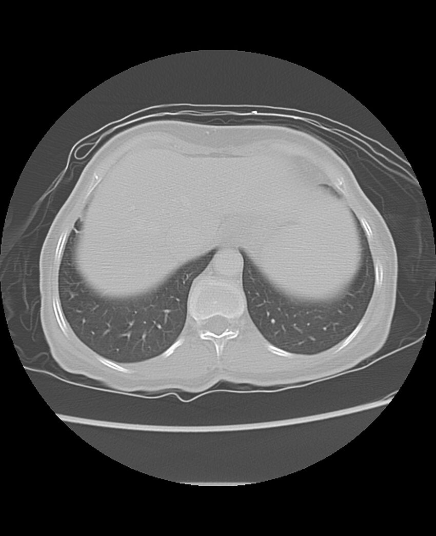 Chondrosarcoma (Radiopaedia 79427-92532 Axial lung window 49).jpg