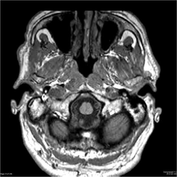 File:Chondrosarcoma of skull base- grade II (Radiopaedia 40948-43654 Axial T1 8).jpg