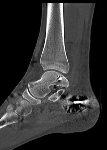 File:Chopart fracture (Radiopaedia 35347-36861 Sagittal bone window 40).jpg