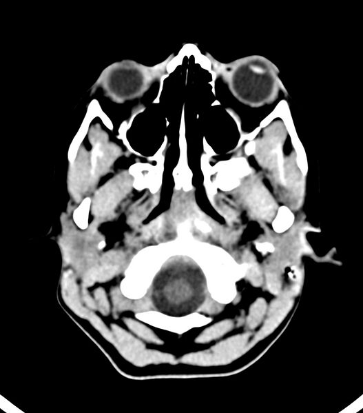 File:Choroid plexus carcinoma (Radiopaedia 91013-108552 Axial non-contrast 8).jpg