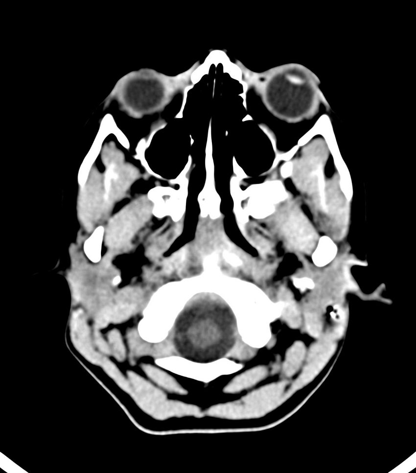 Choroid plexus carcinoma (Radiopaedia 91013-108552 Axial non-contrast 8).jpg