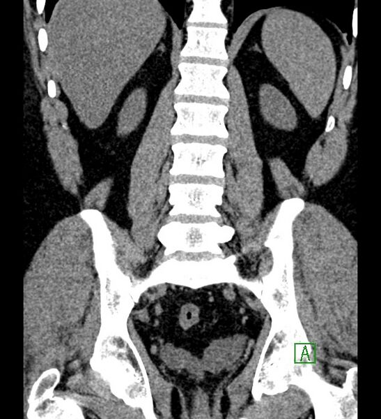 File:Chromophobe renal cell carcinoma (Radiopaedia 84286-99573 Coronal non-contrast 124).jpg