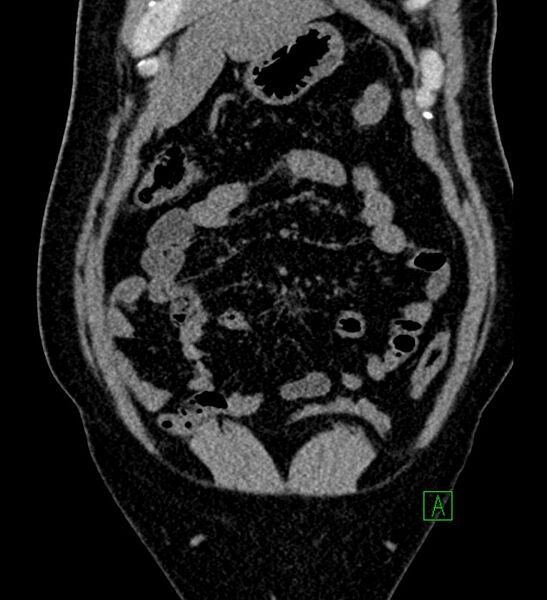 File:Chromophobe renal cell carcinoma (Radiopaedia 84286-99573 Coronal non-contrast 36).jpg