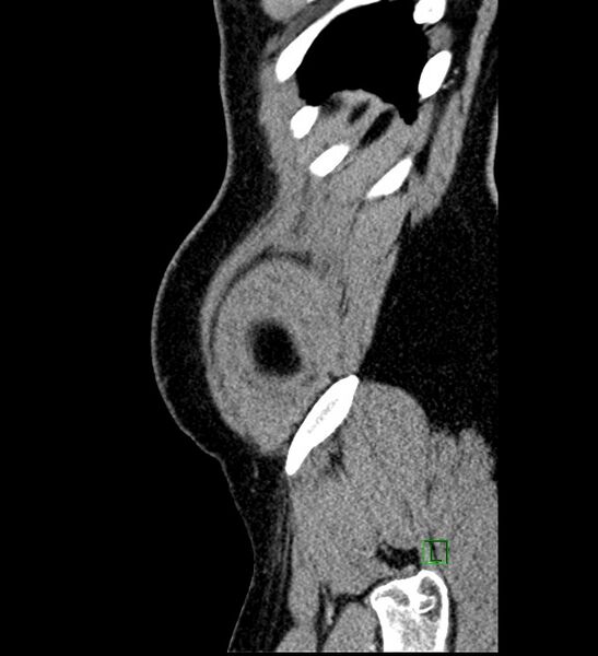 File:Chromophobe renal cell carcinoma (Radiopaedia 84286-99573 I 2).jpg