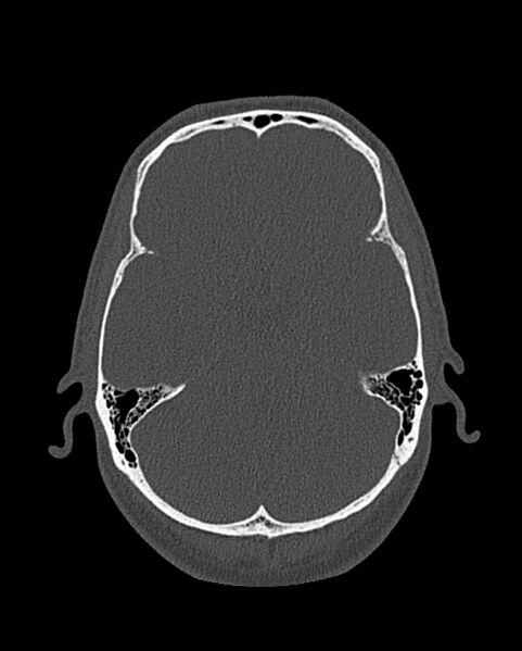 File:Chronic maxillary sinusitis caused by a foreign body (Radiopaedia 58521-65676 Axial bone window 295).jpg