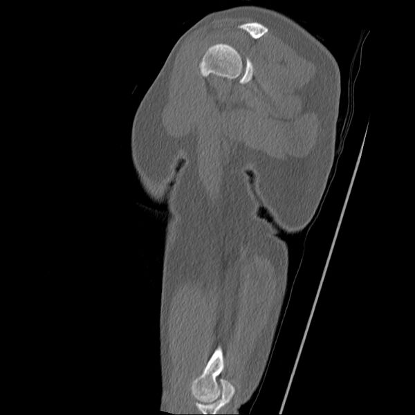 File:Chronic osteomyelitis (Radiopaedia 67597-76998 Sagittal bone window 7).jpg