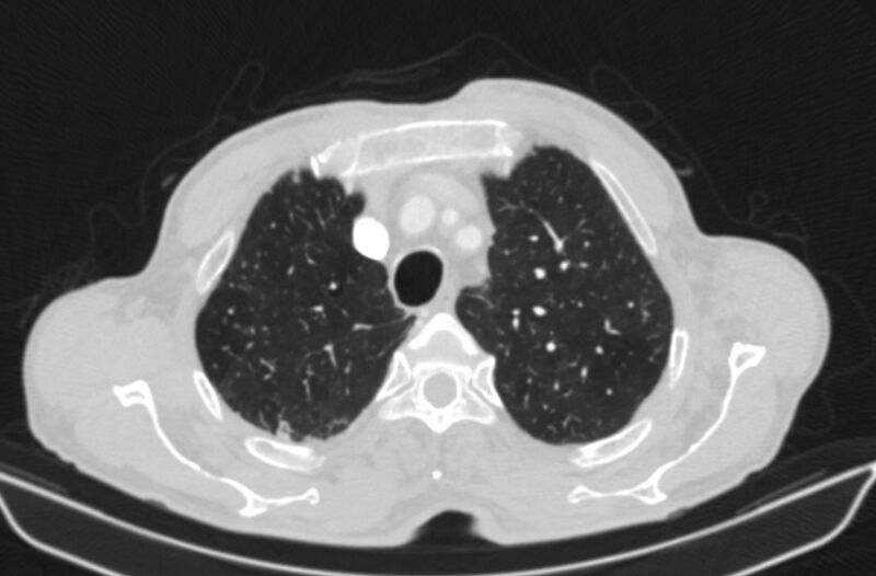 File:Chronic pulmonary embolism (Radiopaedia 91241-108843 Axial lung window 17).jpg