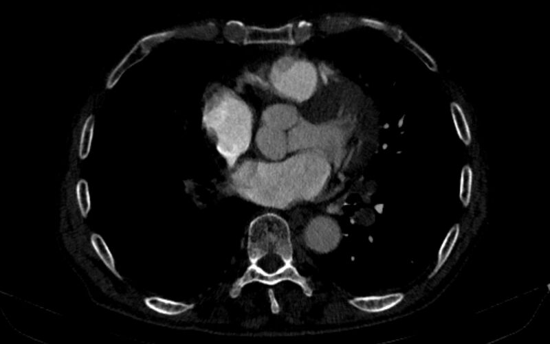 File:Chronic pulmonary embolism (Radiopaedia 91241-108843 B 117).jpg