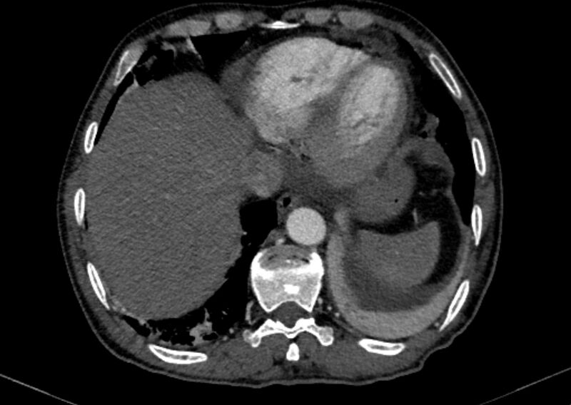 File:Chronic pulmonary embolism with bubbly consolidation (Radiopaedia 91248-108850 C+ arterial phase 123).jpg