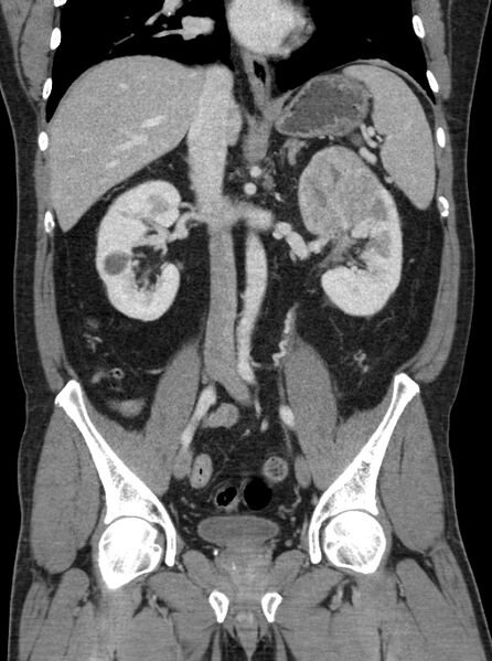 File:Clear cell renal cell carcinoma (Radiopaedia 61449-69393 F 21).jpg
