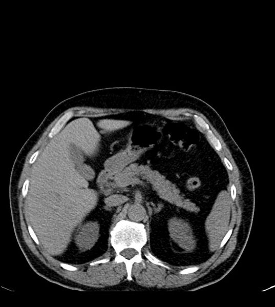 File:Clear cell renal cell carcinoma (Radiopaedia 85006-100539 Axial non-contrast 28).jpg