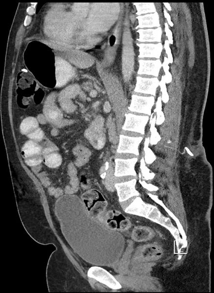 File:Closed loop obstruction - internal hernia into nephrectomy bed (Radiopaedia 59867-67320 C 47).jpg