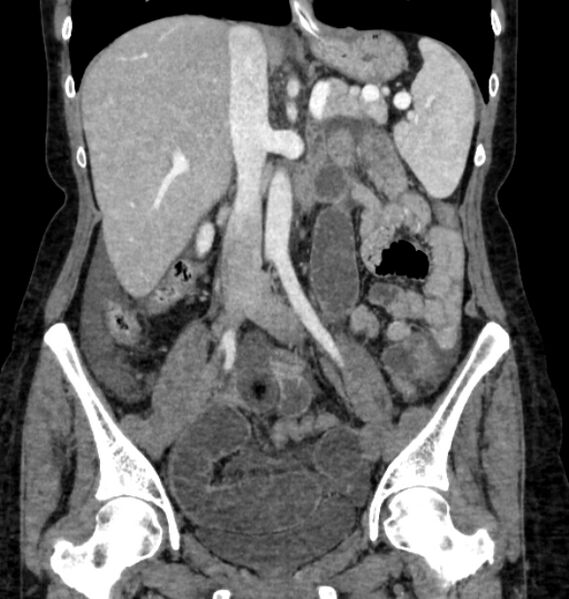 File:Closed loop small bowel obstruction (Radiopaedia 71211-81508 B 60).jpg