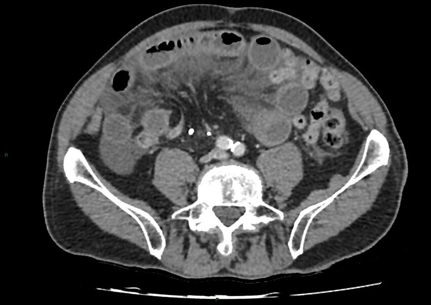 Closed loop small bowel obstruction with ischemia (Radiopaedia 84180-99456 A 77).jpg