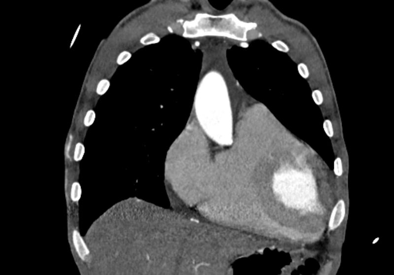 File:Coarctation of aorta with aortic valve stenosis (Radiopaedia 70463-80574 C 45).jpg