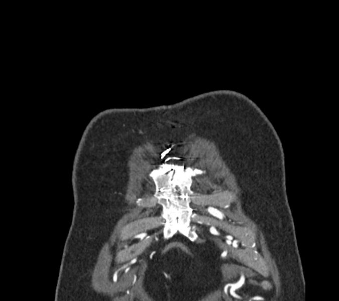 File:Coarctation of the aorta (Radiopaedia 53752-59822 B 4).jpg