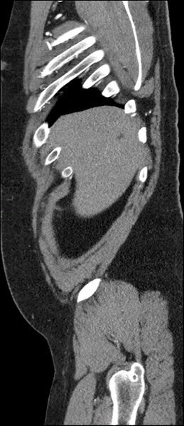 File:Coarctation of the aorta (Radiopaedia 74632-88521 C 28).jpg
