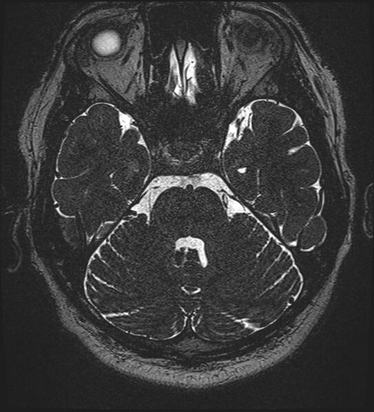 File:Cochlear incomplete partition type III associated with hypothalamic hamartoma (Radiopaedia 88756-105498 Axial T2 105).jpg