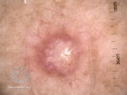 Dermoscopy view of histologically confirmed atypical fibroxanthoma