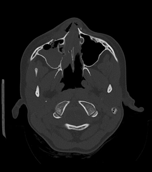 File:Nasoorbitoethmoid fracture (Radiopaedia 90044-107205 Axial bone window 63).jpg