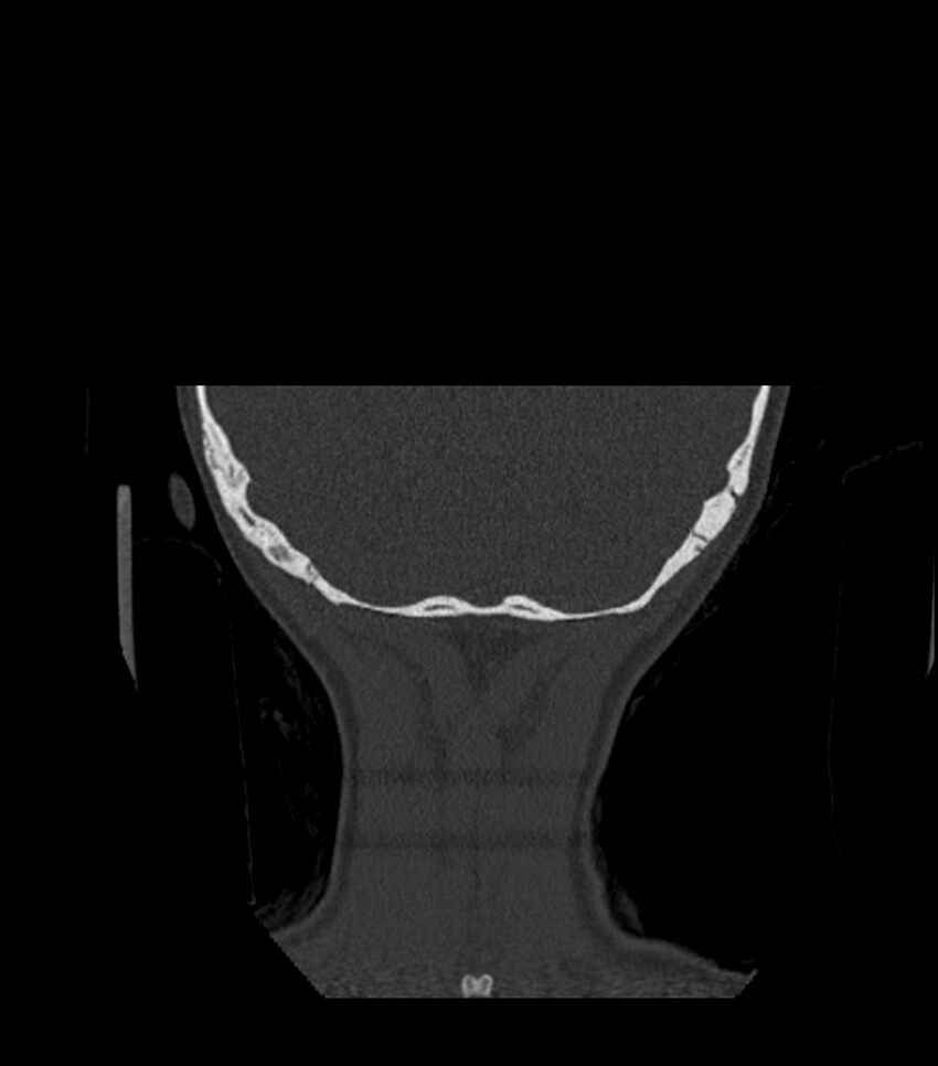 Nasoorbitoethmoid fracture (Radiopaedia 90044-107205 Coronal bone window 135).jpg