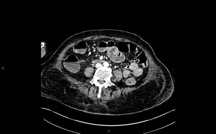 Neo-terminal ileal stricture (Crohn disease) (Radiopaedia 33790-34948 A 257).jpg