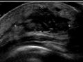 Neonatal mastitis with abscess (Radiopaedia 47089-51629 Transverse 1).jpg