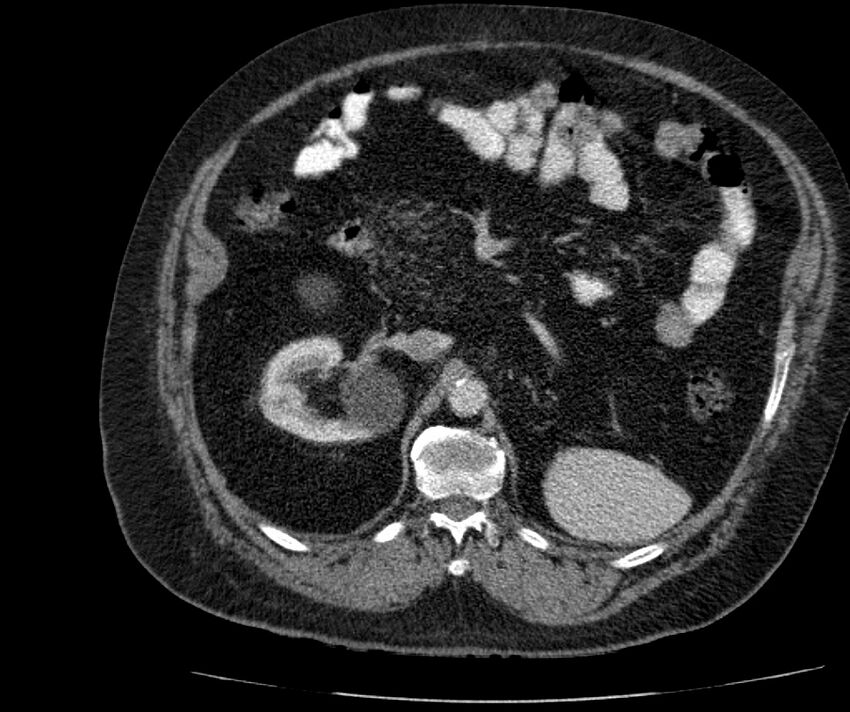 Nephroptosis with inguinal hernia containing perirenal fat (Radiopaedia 56632-63391 C 128).jpg