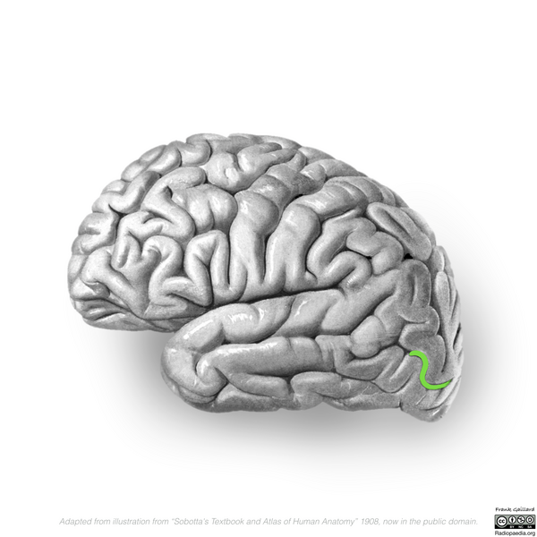 File:Neuroanatomy- lateral cortex (diagrams) (Radiopaedia 46670-51201 I 6).png