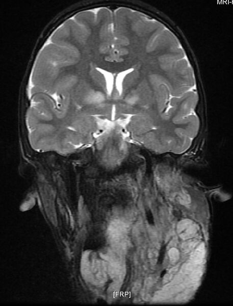 File:Neurofibromatosis type 1 (Radiopaedia 6954-8063 Coronal T2 6).jpg