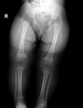 Non-accidental injury (Radiopaedia 47998-52792 Legs 1).png