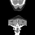 Normal CT of the neck (Radiopaedia 14575-14500 Coronal C+ 48).jpg
