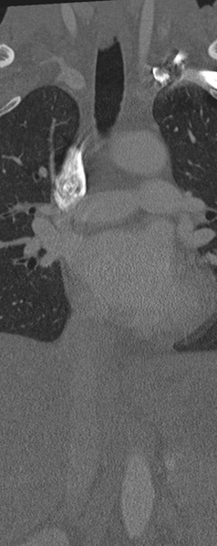 File:Normal CT thoracic spine (Radiopaedia 40181-42688 Coronal bone window 9).png