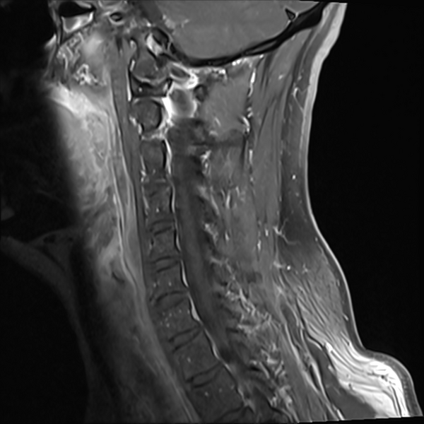 File:Normal MRI cervical spine (infection protocol) (Radiopaedia 53916-60039 I 4).png
