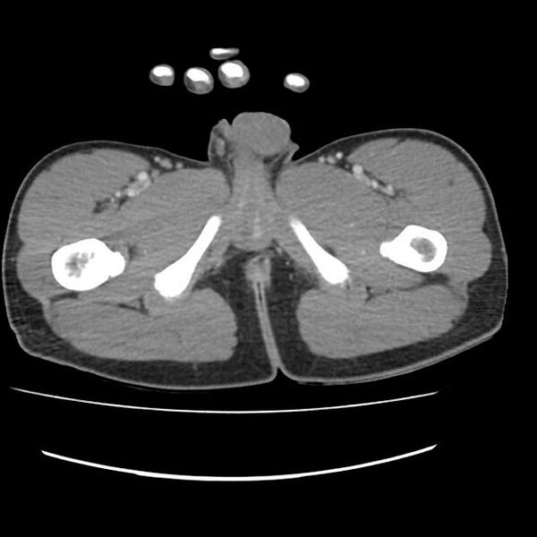 File:Normal dual-phase trauma CT chest,abdomen and pelvis (Radiopaedia 48092-52899 A 122).jpg