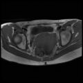 Normal female pelvis MRI (retroverted uterus) (Radiopaedia 61832-69933 Axial T1 19).jpg