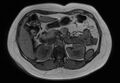 Normal liver MRI with Gadolinium (Radiopaedia 58913-66163 B 17).jpg