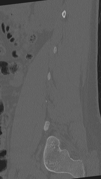 File:Normal lumbar spine CT (Radiopaedia 46533-50986 Sagittal bone window 78).png