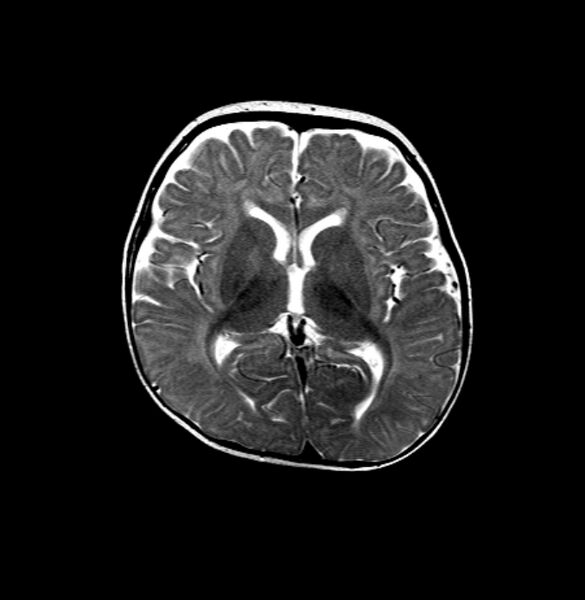 File:Normal myelination 5 month old (Radiopaedia 6814-7982 Axial T2 1).jpg