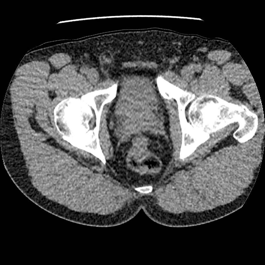 Obstructing ureteric calculus and ureteric anatomy (Radiopaedia 62730-71042 Axial non-contrast 166).jpg