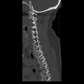 Occipital condyle fracture (Radiopaedia 31755-32691 Sagittal bone window 27).jpg