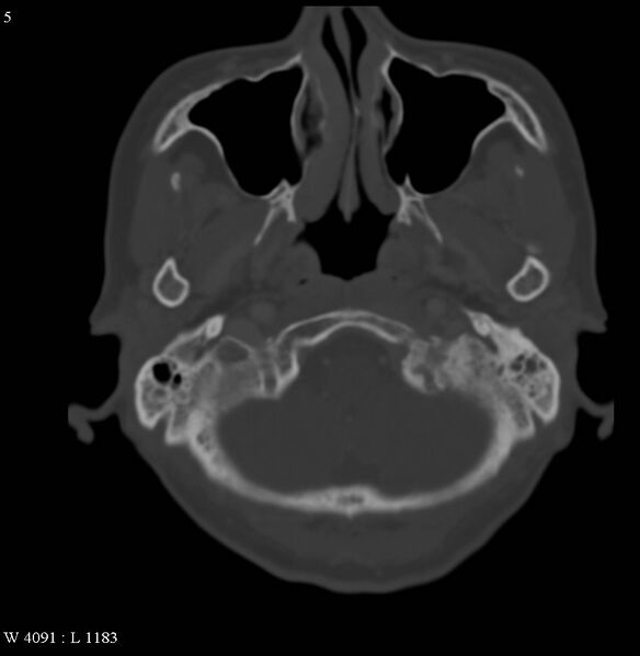 File:Occipital condyle metastasis - into mastoid (Radiopaedia 5424-7177 Axial bone window 5).jpg