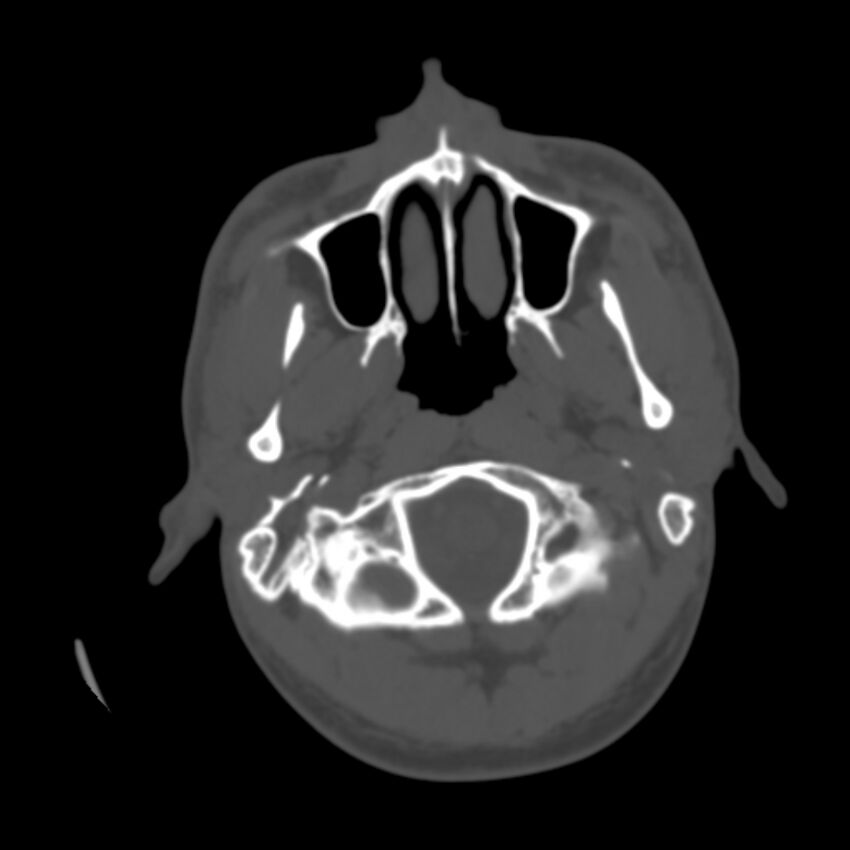 Occipital spur - asymptomatic (Radiopaedia 87753-104201 Axial bone window 3).jpg